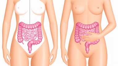 Darstellung von SIBO mit schematischem Dünndarm und Dickdarm sowie Frau mit Bauchschmerzen – Symbolbild für Blähbauch und bakterielle Fehlbesiedlung im Dünndar