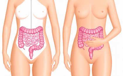 Darstellung von SIBO mit schematischem Dünndarm und Dickdarm sowie Frau mit Bauchschmerzen – Symbolbild für Blähbauch und bakterielle Fehlbesiedlung im Dünndar